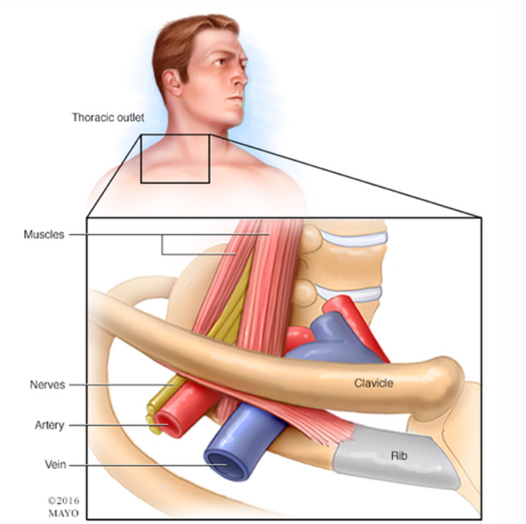 Thoracic outlet syndrome and considerations